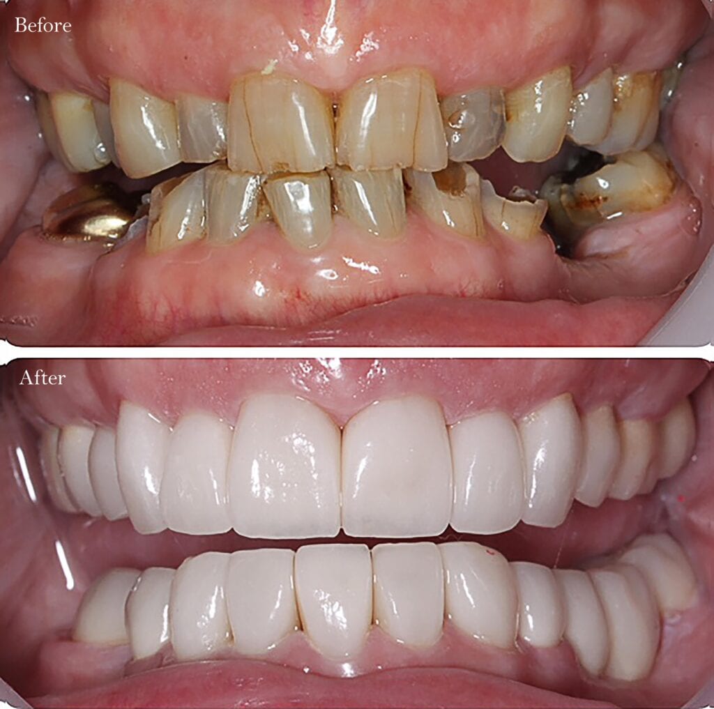 Dental treatment before and after result 7